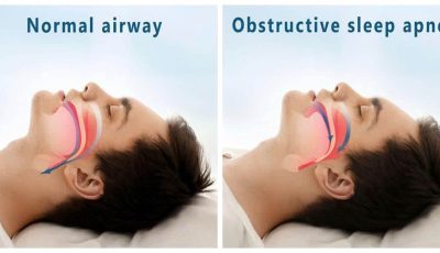 CPAP được ưu tiên trước phẫu thuật ngưng thở khi ngủ trong điều trị hội chứng OSA ở nhiều bệnh nhân