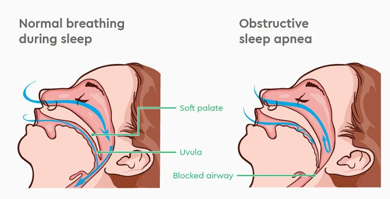 Mô phỏng cơ chế sụt đổ đường hô hấp trên gây ra hội chứng ngưng thở khi ngủ do tắc nghẽn